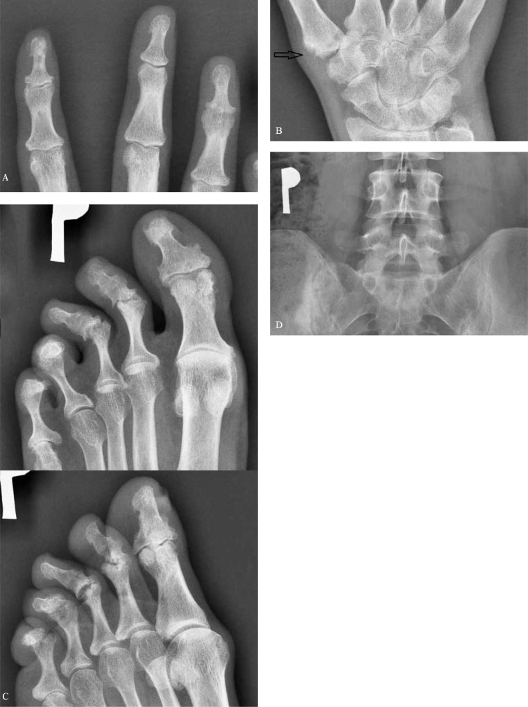 Multiple radiographic views showing polyarticular psoriatic arthritis involving DIP joints, wrists, forefoot, and pelvis with erosive and proliferative changes
