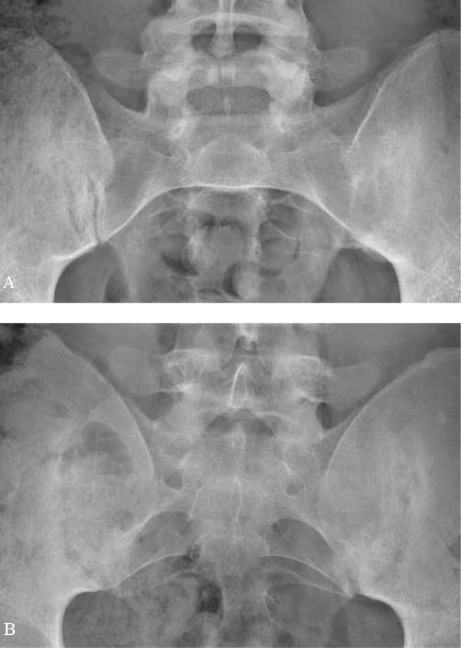 Pelvic radiograph demonstrating bilateral sacroiliitis with joint space narrowing, sclerosis, and erosions of the sacroiliac joints