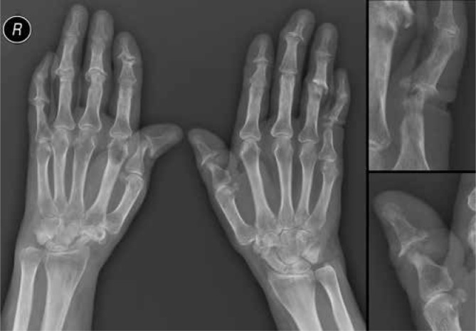 Hand radiograph in psoriatic arthritis showing erosive changes with soft tissue swelling, periosteal new bone formation, and telescoping of digits