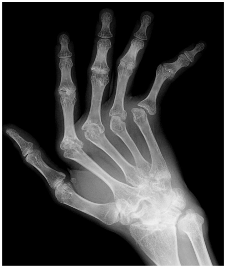Radiograph showing advanced rheumatoid arthritis hand deformities including ulnar deviation, subluxation, and erosive changes