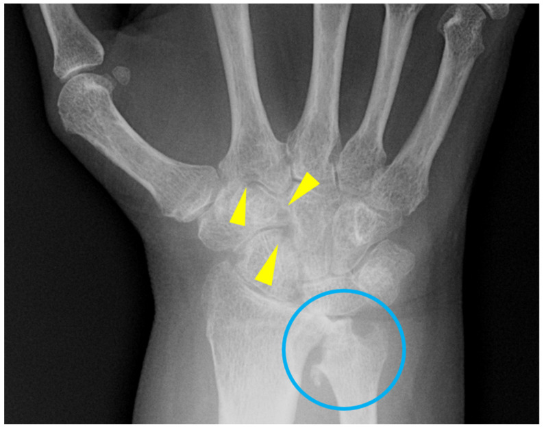 Radiograph of rheumatoid arthritis hands showing periarticular osteopenia, symmetric joint space narrowing, and marginal erosions at MCP and PIP joints