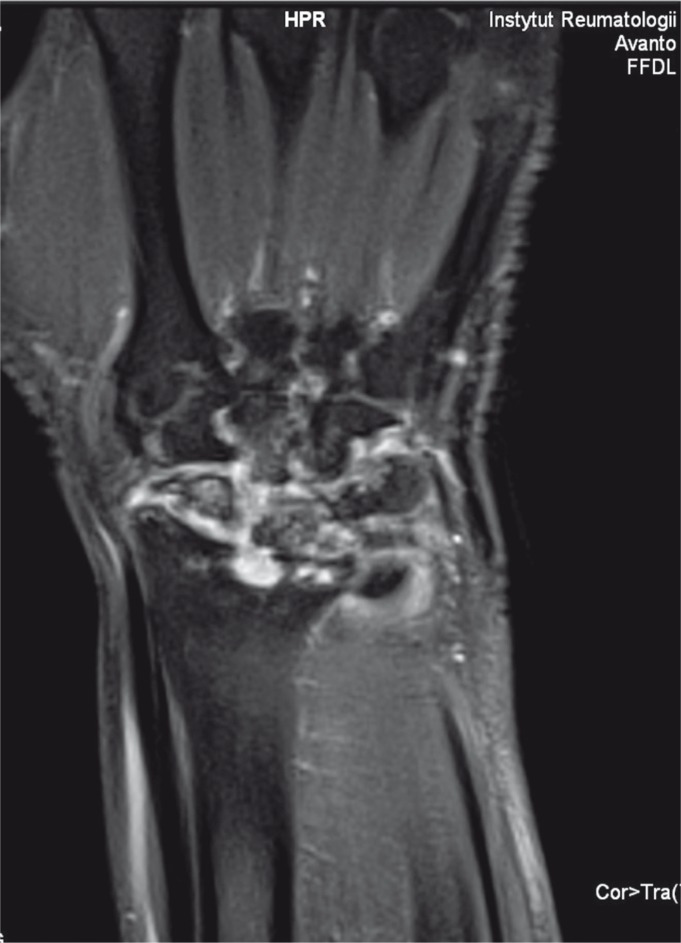 MRI of the wrist and hand in rheumatoid arthritis showing bone marrow edema, synovial enhancement, and early erosive changes
