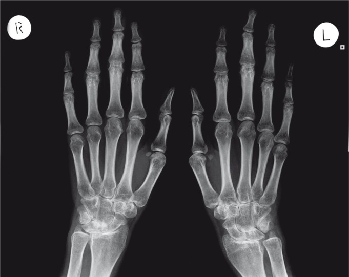Radiograph of the hand demonstrating rheumatoid arthritis with erosive changes at the metacarpophalangeal joints and periarticular osteopenia