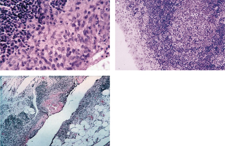 Histopathologic image showing synovial inflammation in rheumatoid arthritis with hyperplastic synovial lining and inflammatory cell infiltrate