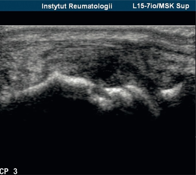 Musculoskeletal ultrasound of a joint showing synovial hypertrophy and power Doppler signal indicating active synovitis in rheumatoid arthritis