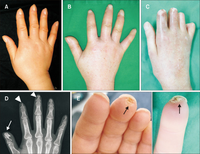 Clinical photograph showing characteristic skin and musculoskeletal changes in systemic sclerosis hands including sclerodactyly, digital contractures, and skin tightening