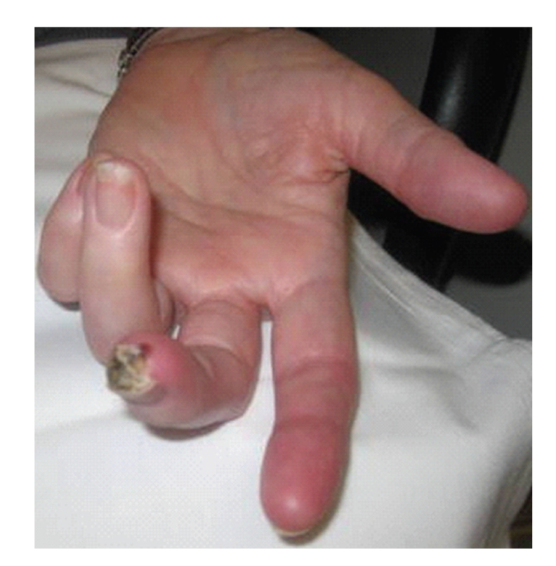 Clinical photograph of a digital ulcer in systemic sclerosis showing necrotic tissue at the distal fingertip with surrounding ischemic changes