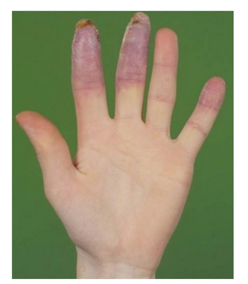 Clinical photograph showing an ischemically threatened digit in scleroderma with cyanotic discoloration and tissue compromise