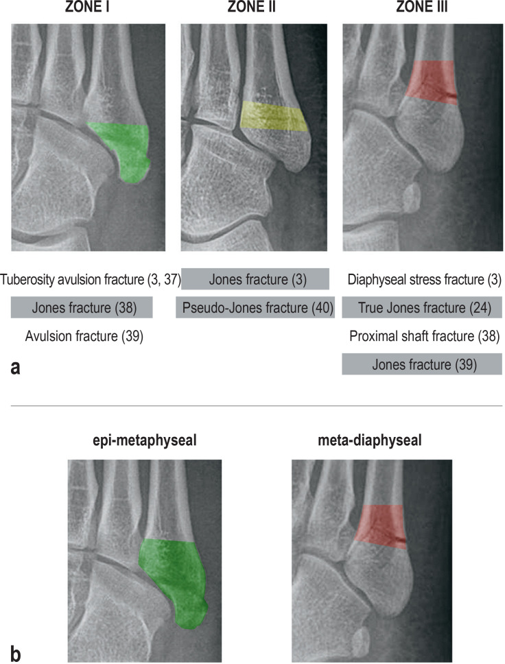 Diagram of the three fracture zones of the proximal fifth metatarsal: Zone 1 tuberosity, Zone 2 metaphyseal-diaphyseal junction, Zone 3 diaphysis
