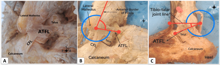 Lateral ankle ligament anatomy showing the ATFL, CFL, and their angular relationships