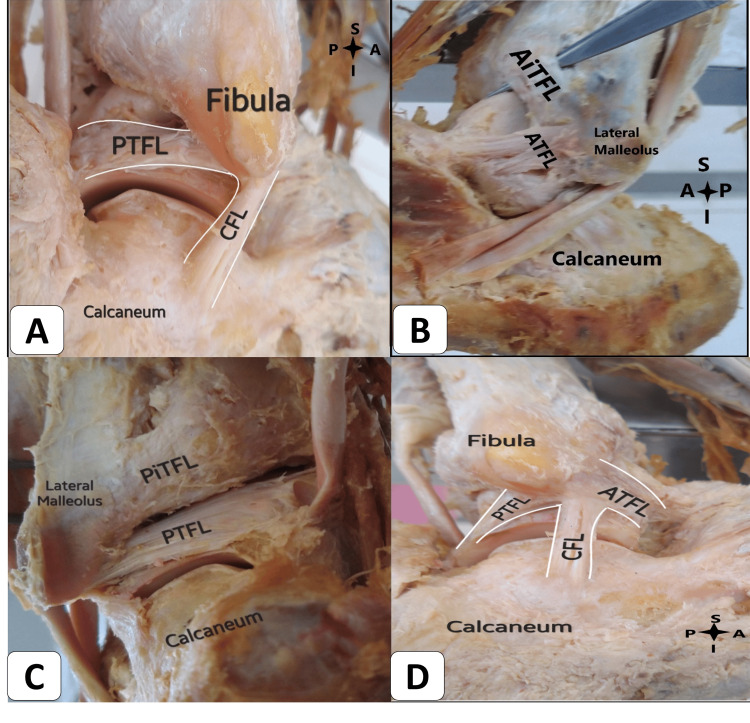 Posterior view of ankle ligament complex showing PTFL, CFL, ATFL, and tibiofibular ligaments