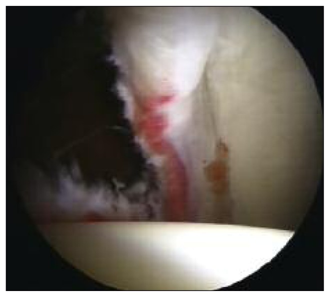 Illustration of pincer-type FAI showing labral contusion and the mechanism of rim impingement