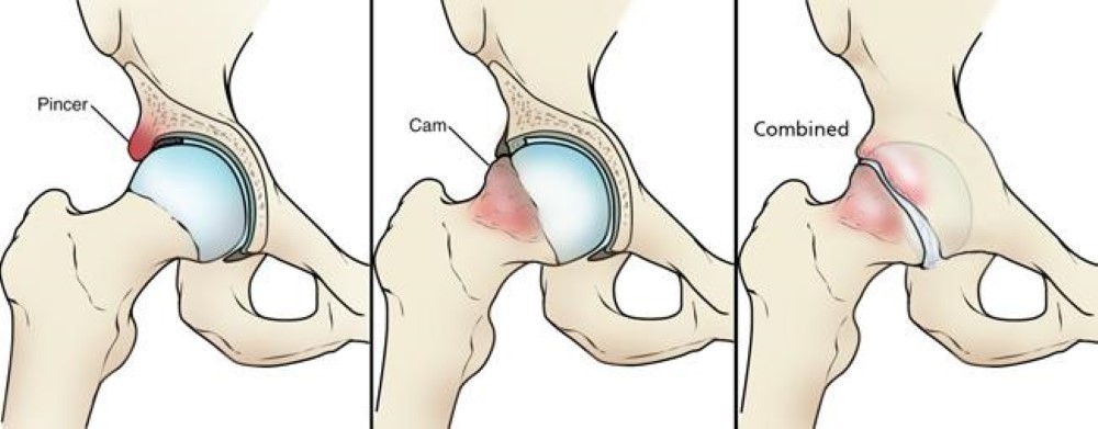Three types of femoroacetabular impingement: pincer (left), cam (center), and combined (right)