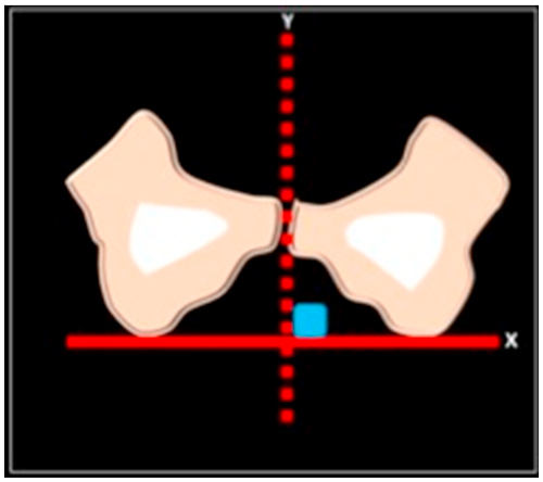 MRI and anatomical illustration of hamstring muscle origin at the ischial tuberosity