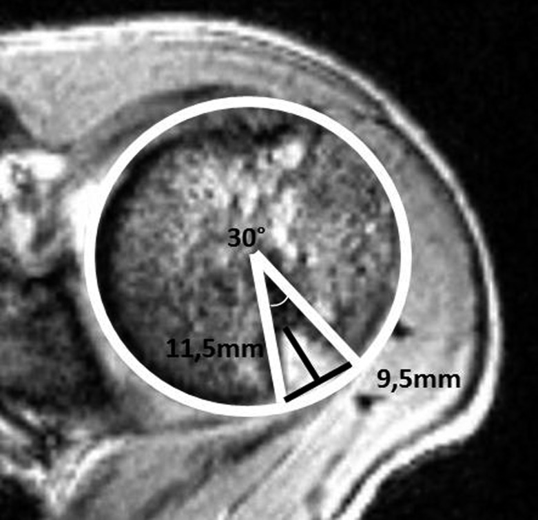 Radiographic image showing a Hill-Sachs lesion of the posterolateral humeral head following anterior shoulder dislocation