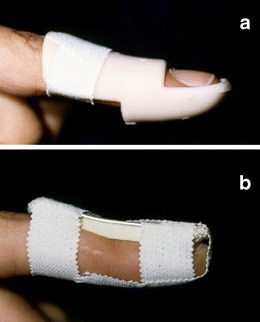 Clinical photograph and splinting options for mallet finger injuries