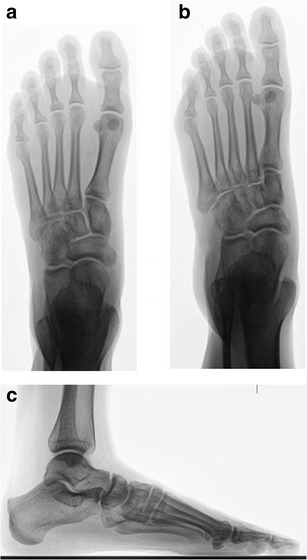 Normal weight-bearing foot radiograph showing Lisfranc joint alignment and key diagnostic lines