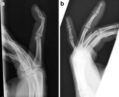 Lateral radiographs comparing tendinous mallet finger and bony mallet finger with dorsal avulsion fragment
