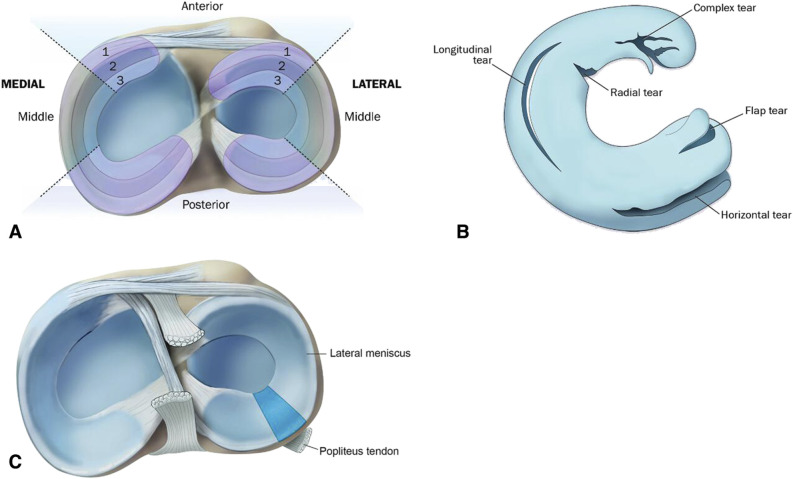 ISAKOS meniscal tear classification system showing tear pattern, rim width, and location parameters