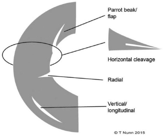 Illustration of meniscal tear patterns including longitudinal, bucket-handle, radial, horizontal, and complex tears