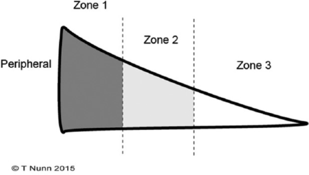 Diagram of meniscal vascular zones showing the red-red, red-white, and white-white zones with decreasing blood supply