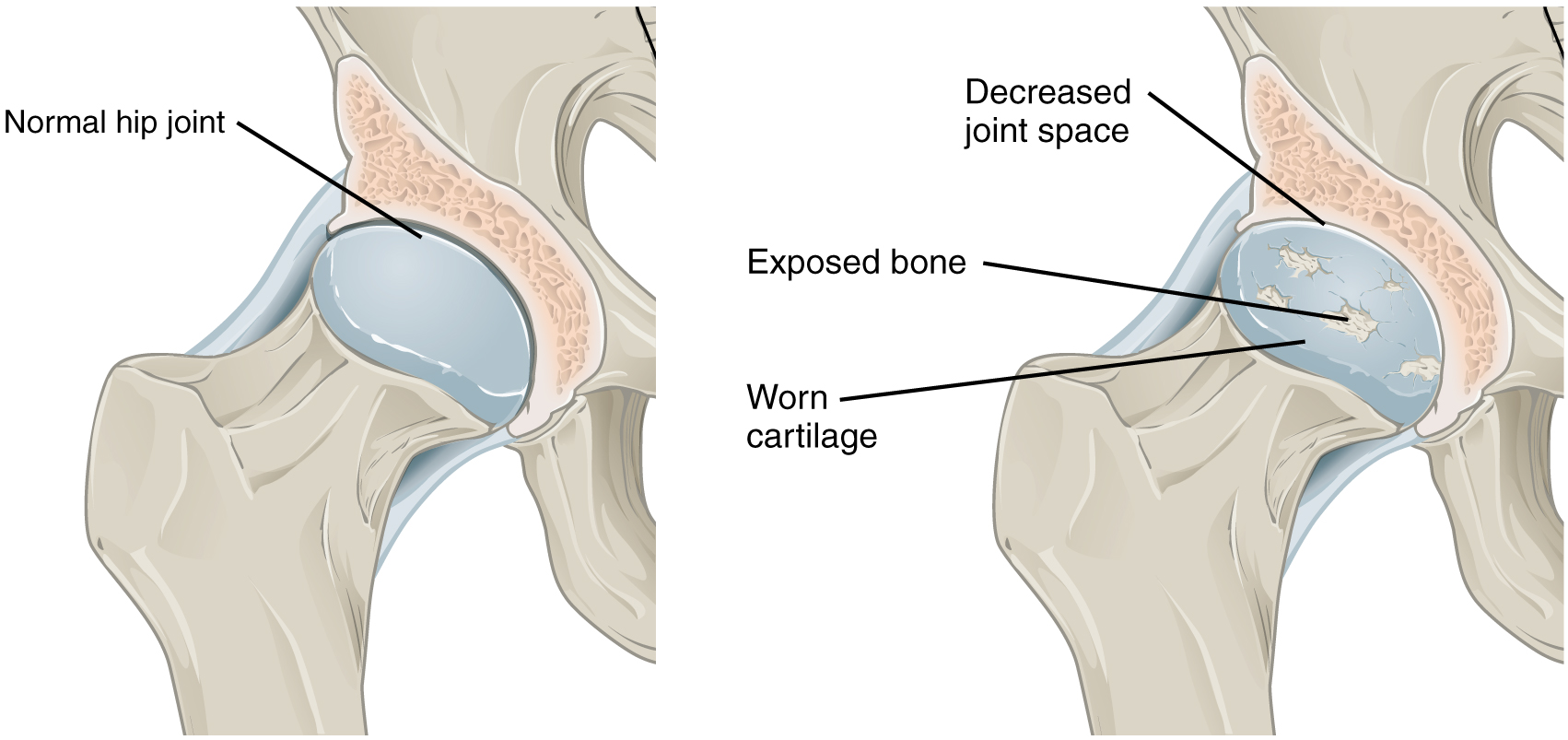 Comparison of a normal joint and an osteoarthritic joint showing cartilage loss, bone spurs, and joint space narrowing