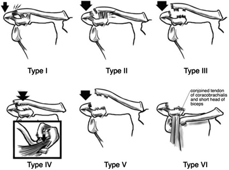 Rockwood classification of acromioclavicular joint separations Types I through VI with anatomical illustrations