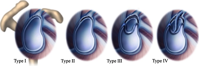 Snyder classification of SLAP tear types I through IV with arthroscopic and schematic illustrations