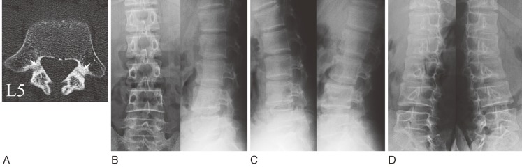 CT scan and plain radiograph showing early spondylolysis pars interarticularis defect