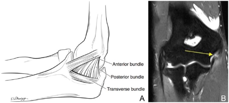 Anatomy of the ulnar collateral ligament of the elbow showing the anterior bundle and MRI of UCL tear
