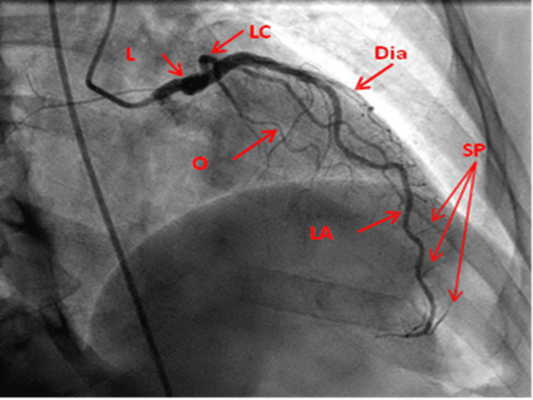 RAO cranial coronary angiography view showing left coronary artery with LAD and diagonal branches
