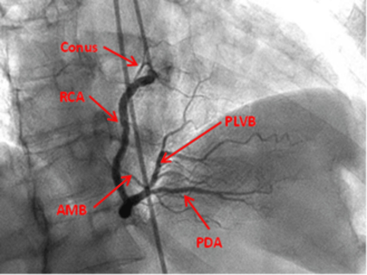 RAO straight view of right coronary artery showing proximal, mid, and distal segments