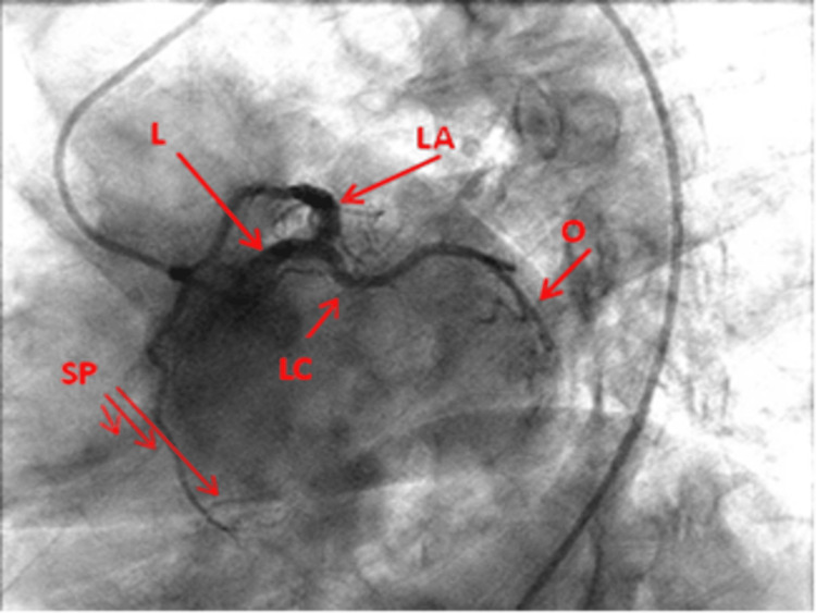 LAO cranial spider view of left coronary artery showing left main bifurcation