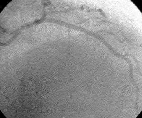 Coronary angiogram after successful stent deployment showing restored TIMI 3 flow