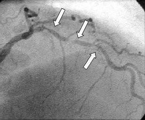 Coronary angiogram showing severe stenosis of a coronary artery before PCI