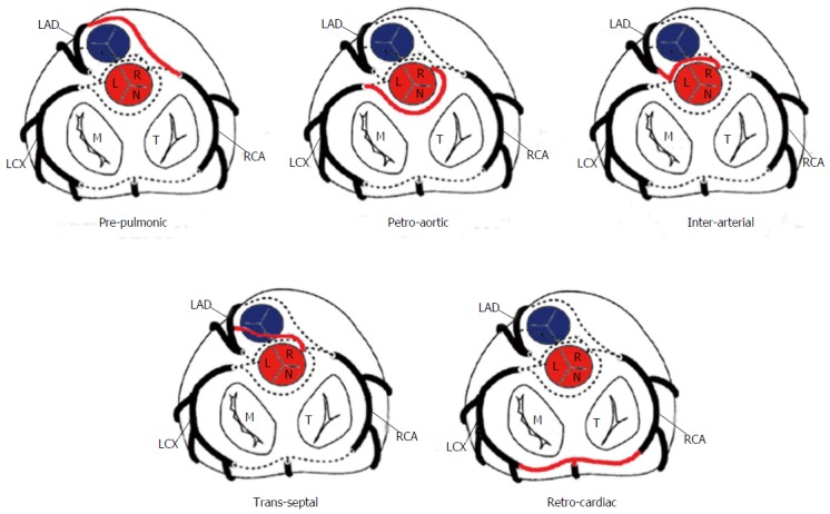 Possible anomalous coronary artery paths including interarterial, retroaortic, prepulmonic, and transseptal courses