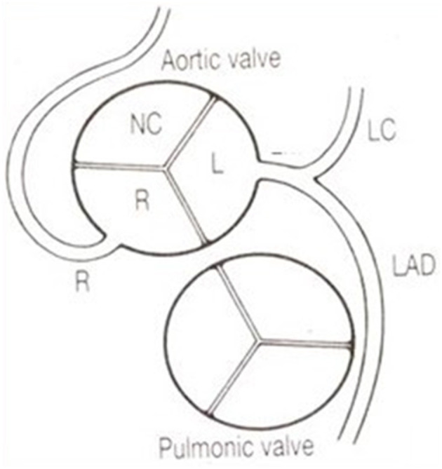 Coronary artery origins from the aortic sinuses of Valsalva with anatomical landmarks