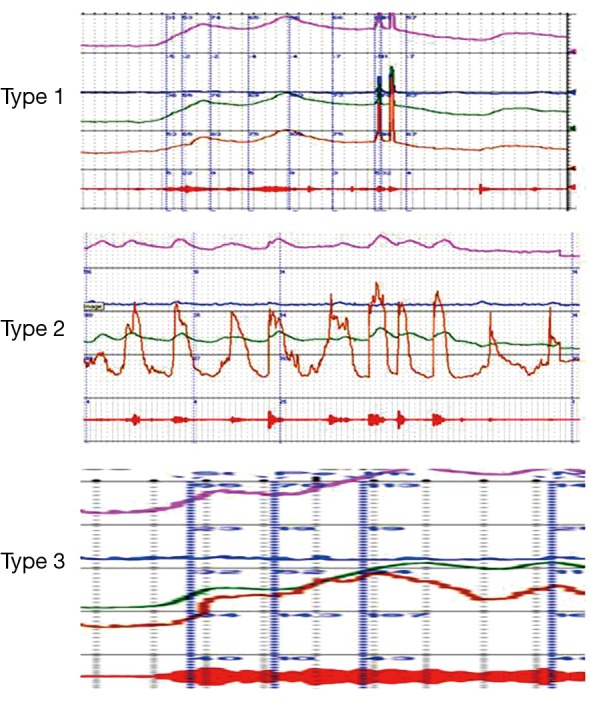 EMG tracings showing Blaivas classification of detrusor-sphincter dyssynergia types I, II, and III