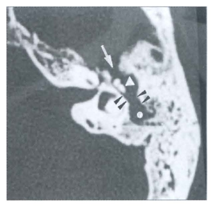 CT showing ossicular chain erosion from cholesteatoma