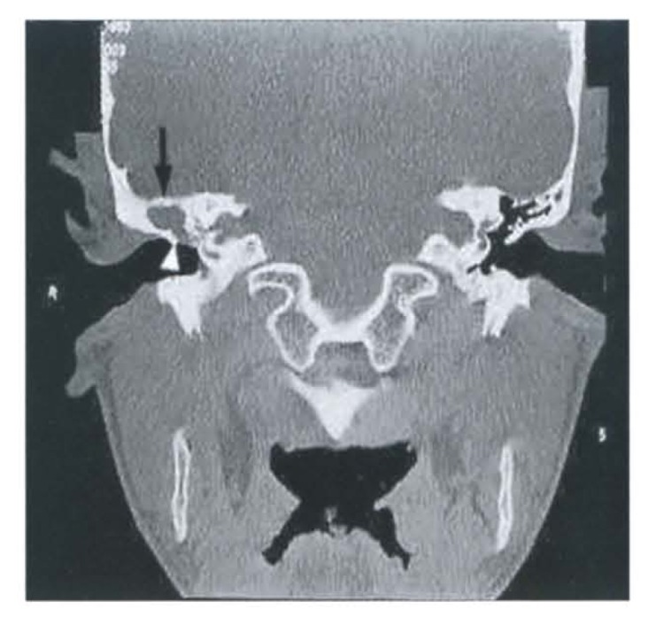 CT temporal bone showing cholesteatoma with middle ear opacification