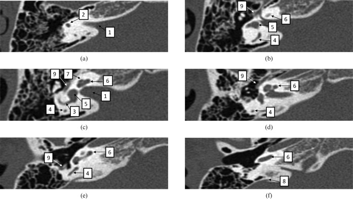 CT scan of the inner ear showing cochlea and semicircular canals