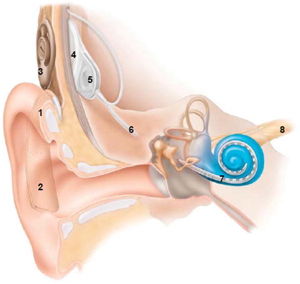 Cochlear implant system showing external and internal components