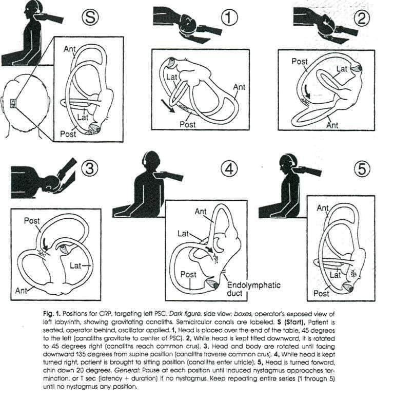 Epley maneuver canalith repositioning procedure steps for posterior canal BPPV