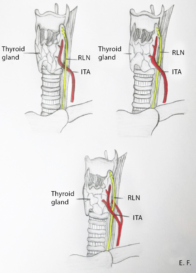 Facial nerve intratemporal course showing labyrinthine, tympanic, and mastoid segments