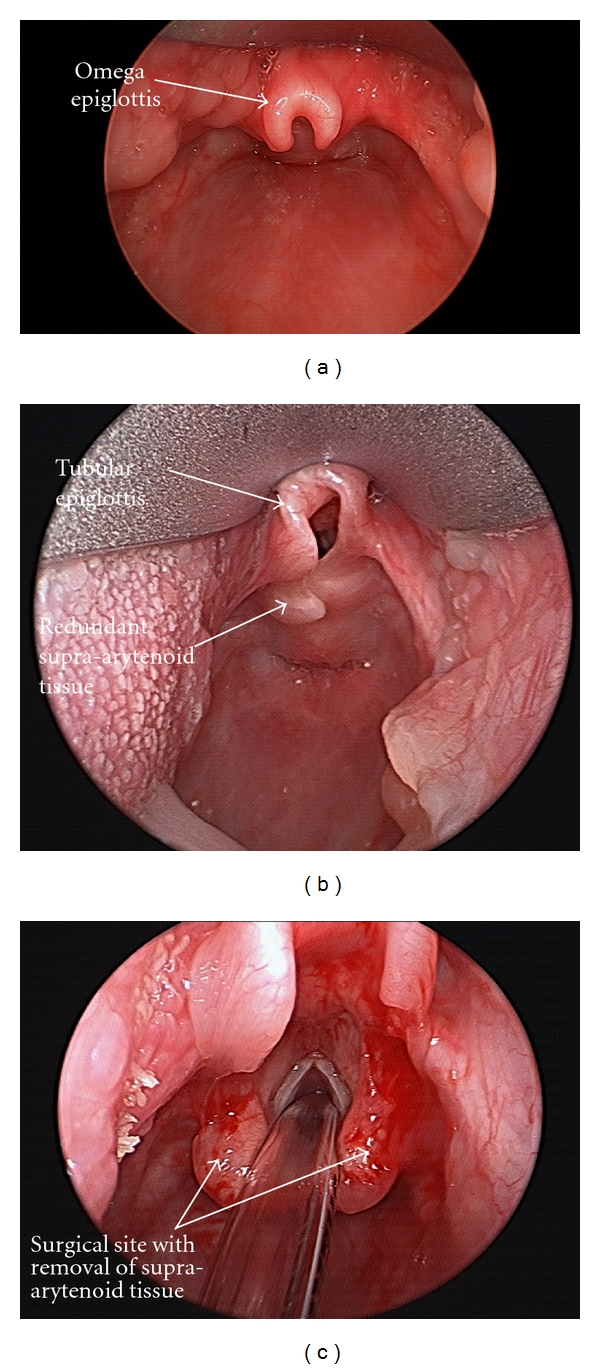 Endoscopic views of laryngomalacia showing omega-shaped epiglottis and redundant arytenoid tissue