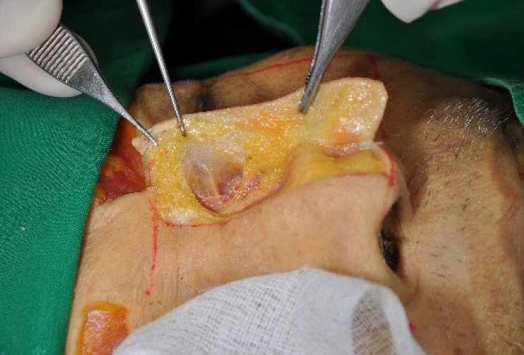 Cervical lymph node levels I through VI for neck dissection planning