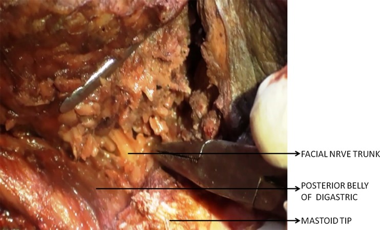 Cadaveric dissection showing facial nerve identification during parotidectomy