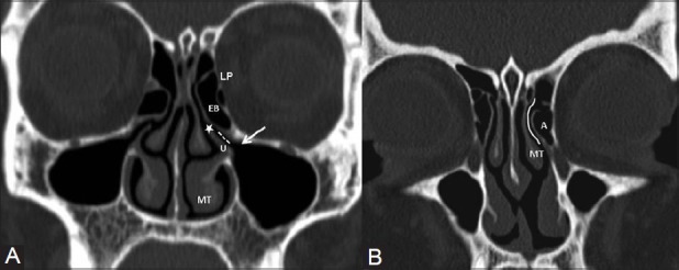 Coronal CT of paranasal sinuses showing normal anatomy and key landmarks