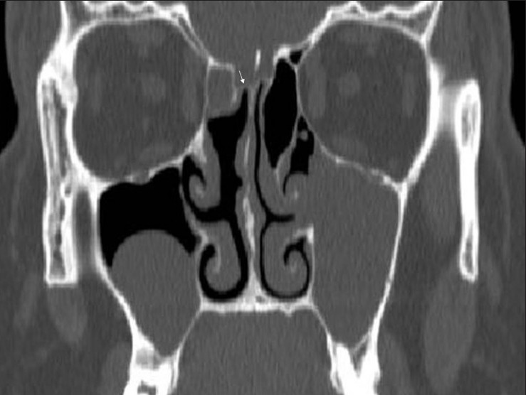 CT showing Keros classification of olfactory fossa depth