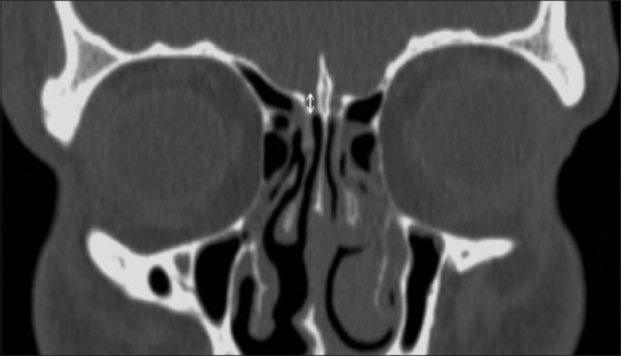 CT showing Onodi cell with close relationship to optic nerve